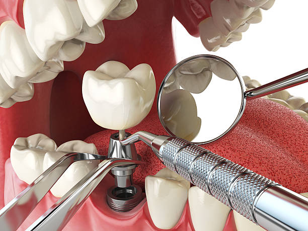 Best Emergency Wisdom Teeth Removal in Calvert, TX